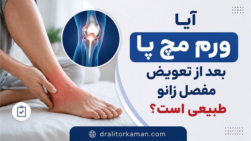 ورم مچ پا بعد از تعویض مفصل زانو