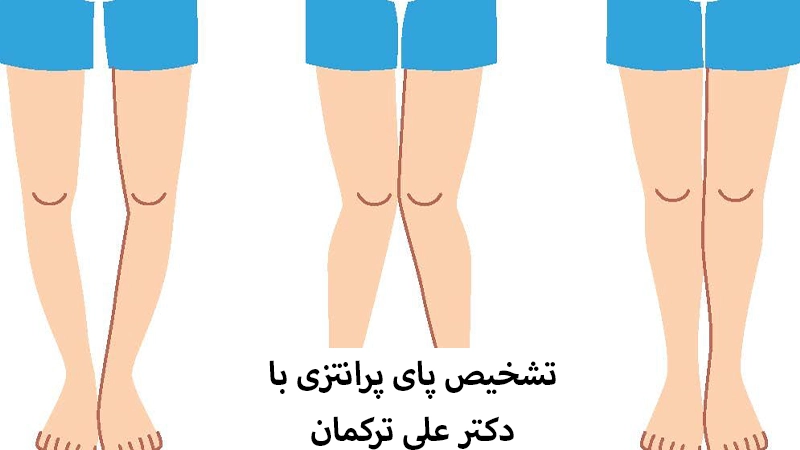 تشخیص پای پرانتزی با دکتر علی ترکمان