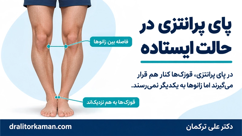 پای پرانتزی چیست و در حالت ایستاده چه شکلی دارد