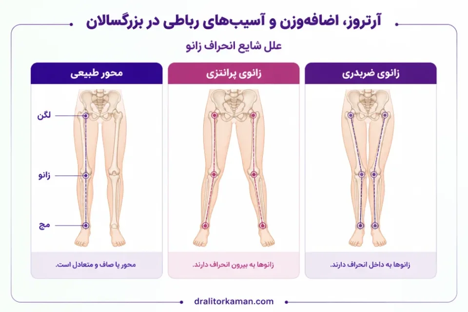 نمای توضیحی درباره آرتروز، اضافهوزن و آسیبهای رباطی در بزرگسالان